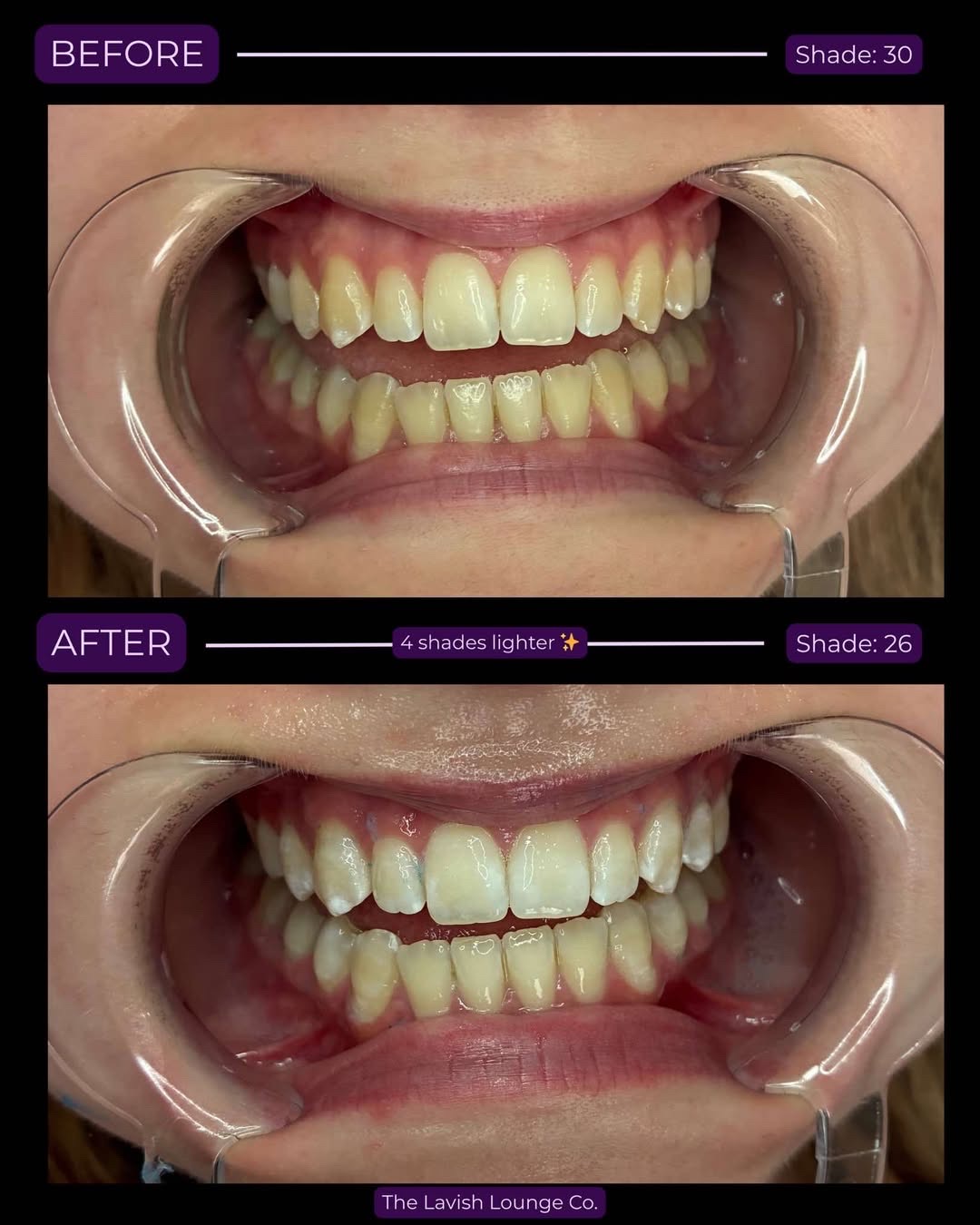Before and after teeth whitening — 4 shades lighter