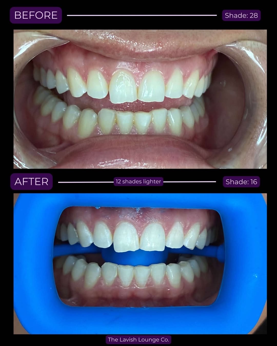 Before and after teeth whitening — 12 shades lighter