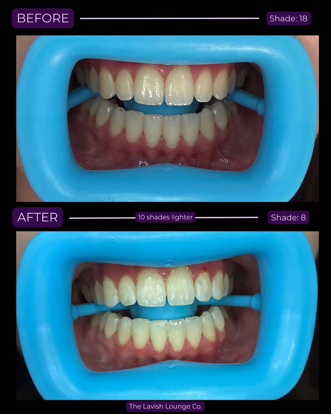 Before and after teeth whitening — 10 shades lighter